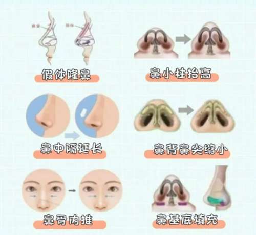 鼻综合 鼻综合