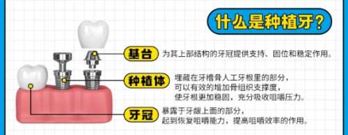 牙齿种植