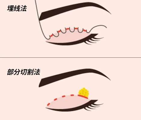 双眼皮