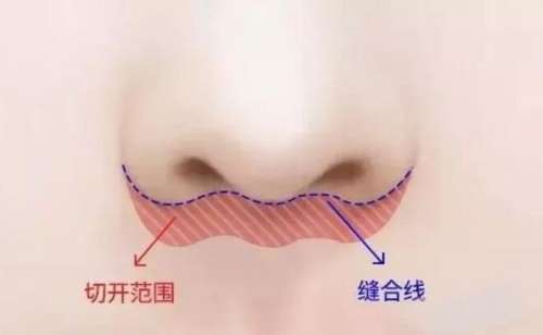 人中缩短 人中缩短