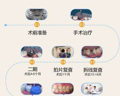 牙齿种植