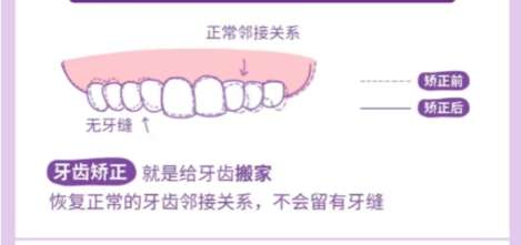 牙齿矫正