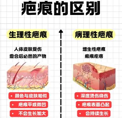 祛疤 祛疤
