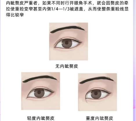 双眼皮 双眼皮