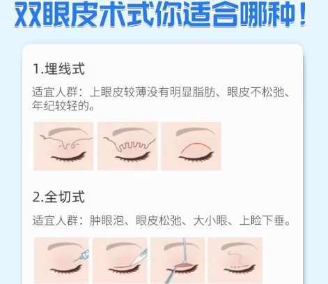 双眼皮 双眼皮