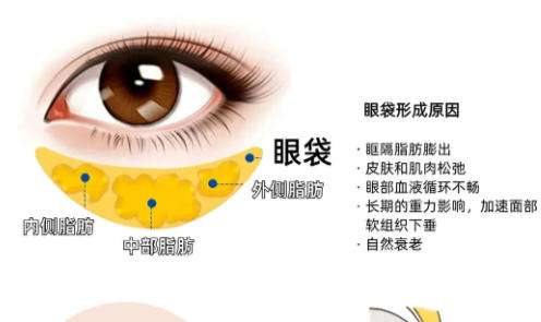 眼袋2.jpg 眼袋2.jpg