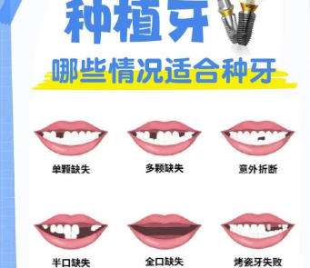 牙齿种植