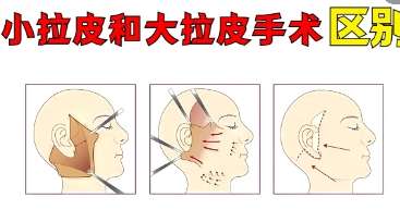 拉皮 拉皮