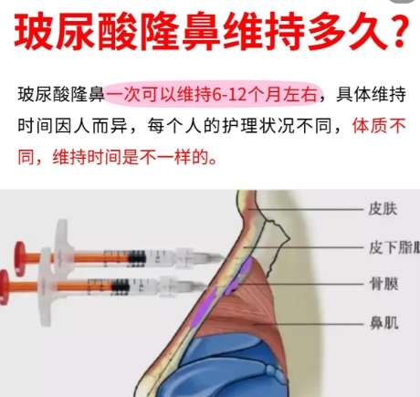 隆鼻 隆鼻