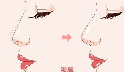 隆鼻 隆鼻