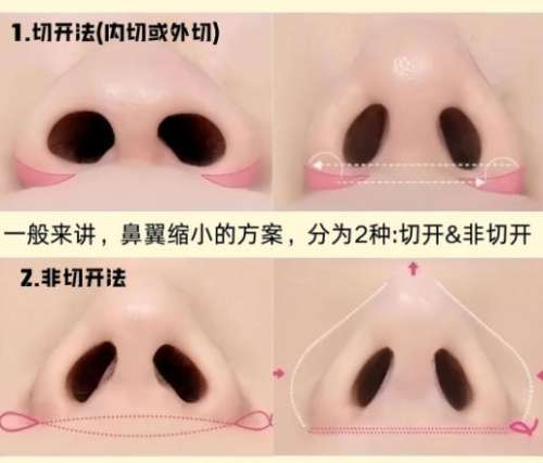 隆鼻12.jpg 隆鼻12.jpg