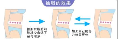 吸脂瘦身01.jpg