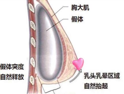 隆胸 隆胸