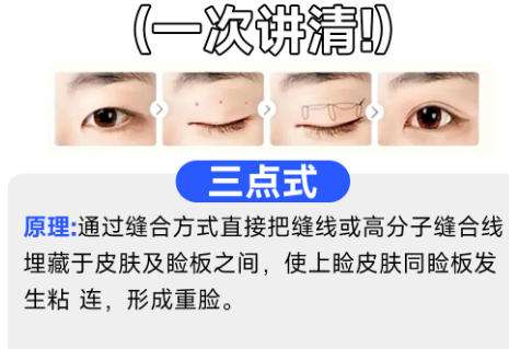 双眼皮6.jpg