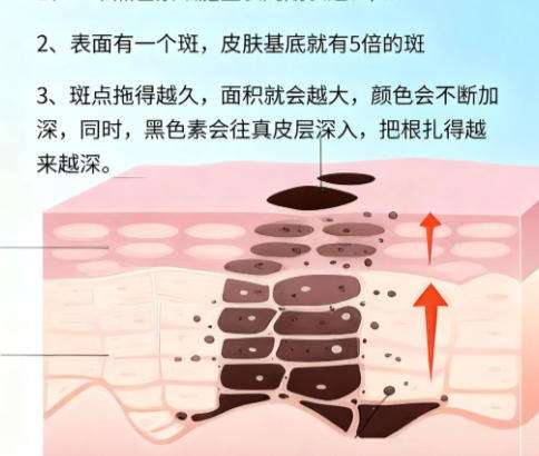 激光祛斑1.jpg 激光祛斑1.jpg