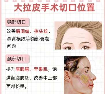 拉皮 拉皮