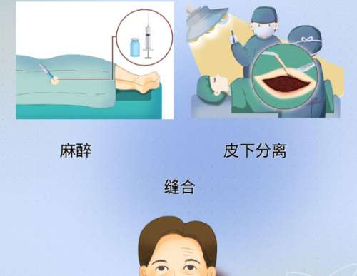拉皮