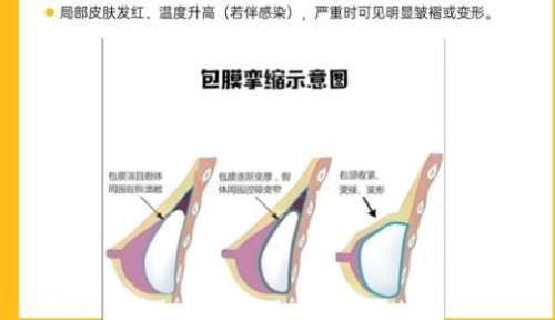 隆胸4.jpg 隆胸4.jpg