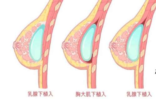 隆胸 隆胸