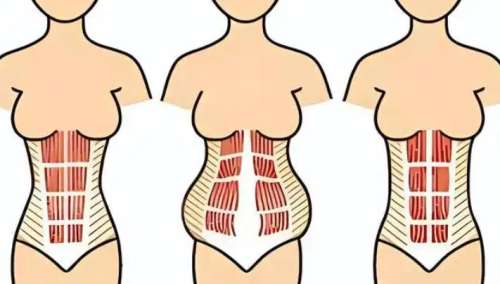 腹壁整形 腹壁整形