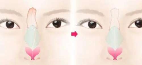 歪鼻矫正动漫03.jpg 歪鼻矫正动漫03.jpg