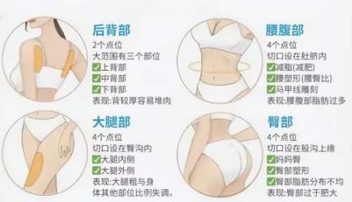 吸脂