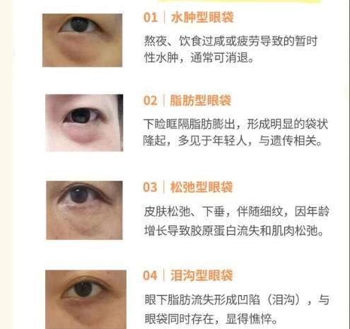 眼袋7.jpg 眼袋7.jpg