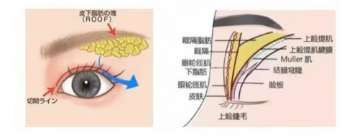 双眼皮 双眼皮
