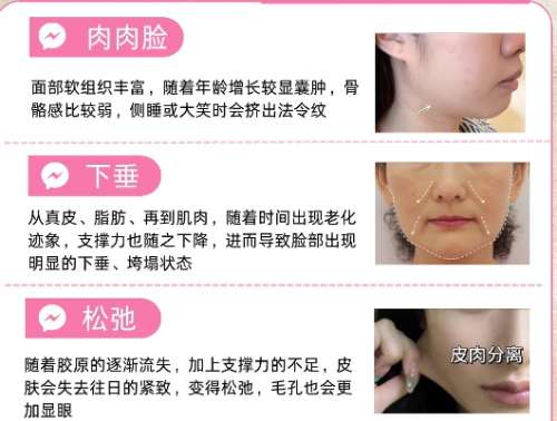 热玛吉
