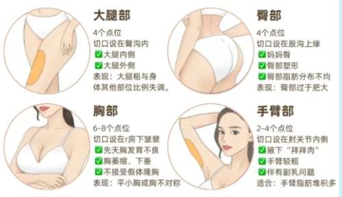 吸脂 吸脂
