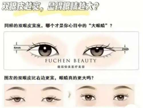 双眼皮