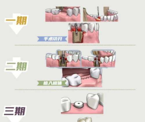 牙齿种植