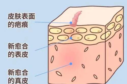 瘢痕