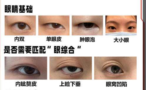 双眼皮 .jpg 双眼皮 .jpg