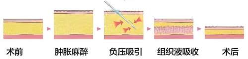吸脂