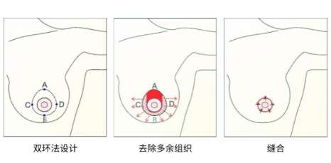 缩胸 缩胸