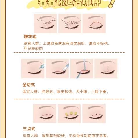 双眼皮 双眼皮