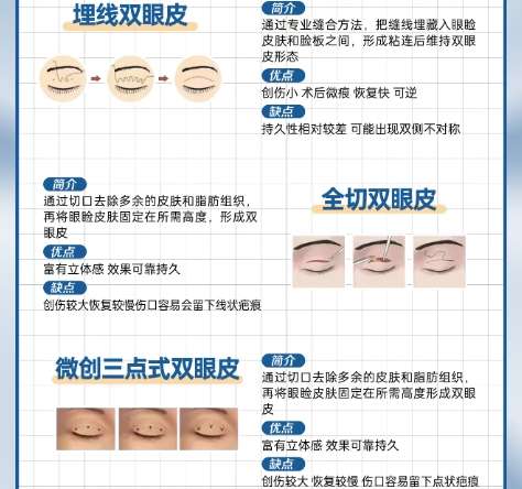 双眼皮 双眼皮
