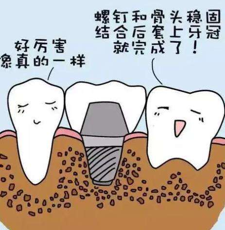 包头种一颗牙大概要多少钱？优势和弊端get