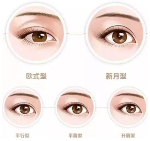 重庆双眼皮埋线价格多少？埋线法费用及适应人群解析