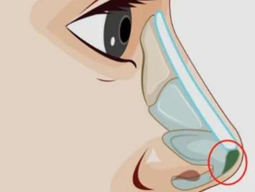 上海隆鼻手术大概价位是多少？推荐几家口碑好又实惠的机构！