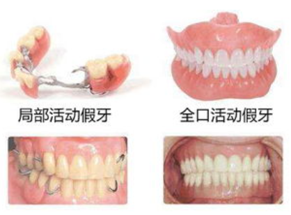 北京种植牙价格大概是多少？你想知道的各品牌种植体费用一览，建议收藏
