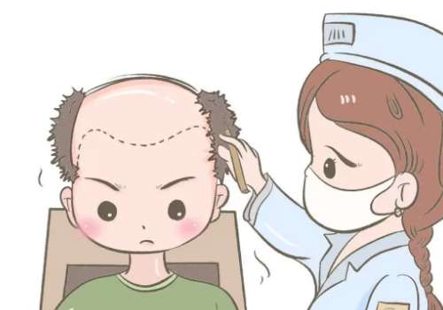 嘉兴第一医院植发多少钱？发际线种植1.5万起，一篇讲清重点，不踩坑