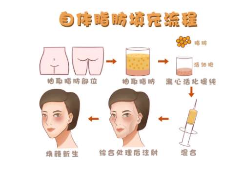 协和王晓军脂肪填充的价格！2025参考价格1万元起！附医生优势特色揭密