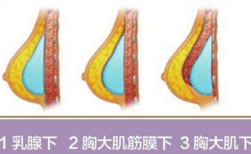 做乳房下垂多少钱？有哪些风险？价格明细查询
