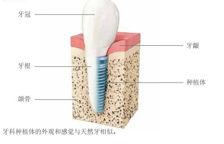 沈阳种植牙一颗多少钱？不同品牌种植体价格公开
