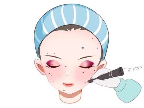 激光点痦子多少钱一个 