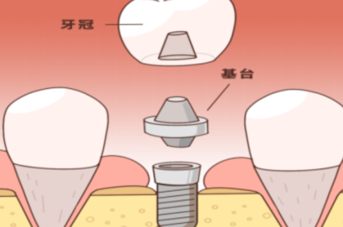 长沙种植牙齿多少钱一颗？不同品牌、方案、医院收费差距有多大