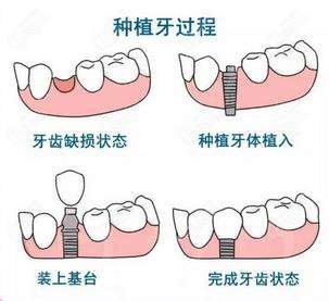 汕头奥诗卡口腔医院简介-种牙\矫正牙齿价格表2026速查