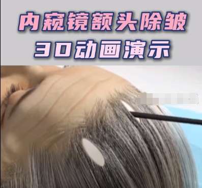 哈尔滨内窥镜额部除皱术多少钱？2万元左右起|性价比机构有哪些？